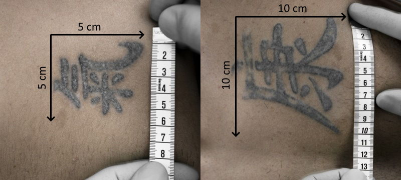 Grösse des Tattoos für die Tattooentfernung in Winterthur ausmessen – Länge und Breite in Zentimetern