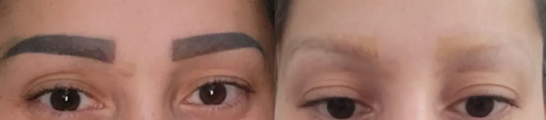 Microblading-Entfernung nach 4 Behandlungen in Winterthur