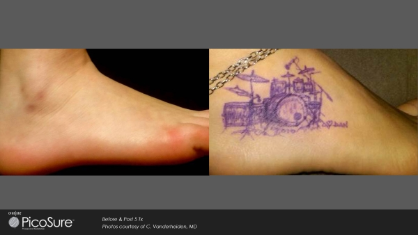 Vorher-Nachher Foto einer Tattooentfernung nach nur 5 Behandlungen mit dem PicoSure-Laser