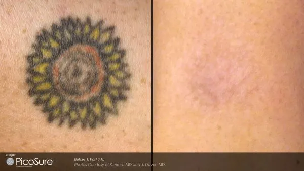 Vorher-Nachher Foto einer Tattooentfernung nach nur 4 Behandlungen mit dem PicoSure-Laser