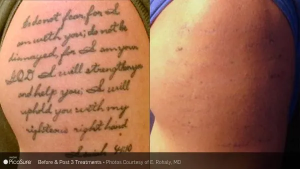 Vorher-Nachher Foto einer Tattooentfernung nach nur 3 Behandlungen mit dem PicoSure-Laser