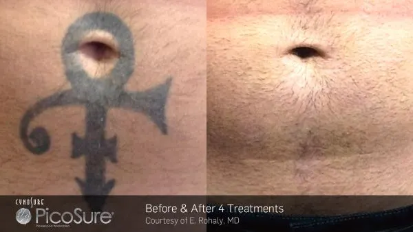 Vorher-Nachher Foto einer Tattooentfernung nach nur 4 Behandlungen mit dem PicoSure-Laser