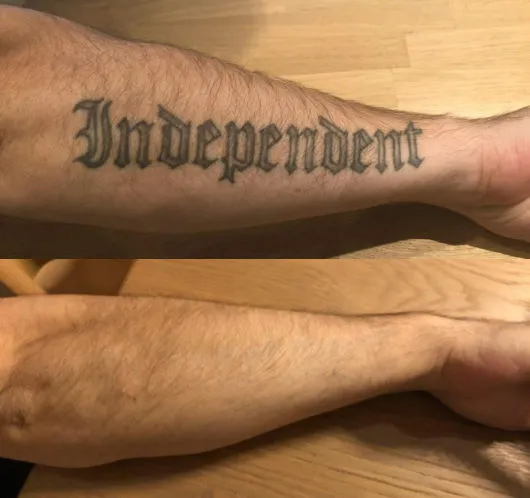 Tattooentfernung nach 6 Behandlungen mit dem PicoSure-Laser in Winterthur