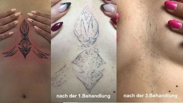 Tattoo-Entfernung mit Laser in Balingen 