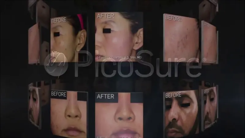 Vorschaubild: Video über den PicoSure-Laser